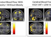 Το κρυμμένο λίπος «προβλέπει» το Αλτσχάιμερ 20 χρόνια πριν την εμφάνιση των πρώτων συμπτωμάτων